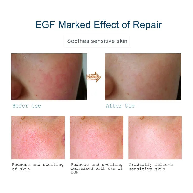 ARTISCARE EGF Acne & Blackhead Repair Face Serum