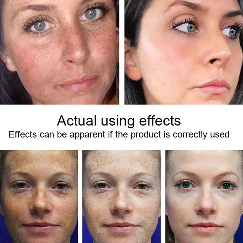 Vitamin C Whitening Freckles Serum Cream Remove Dark Spots Melasma Niacinamide Lighten Melanin Acne Scars Anti-aging Skin Care