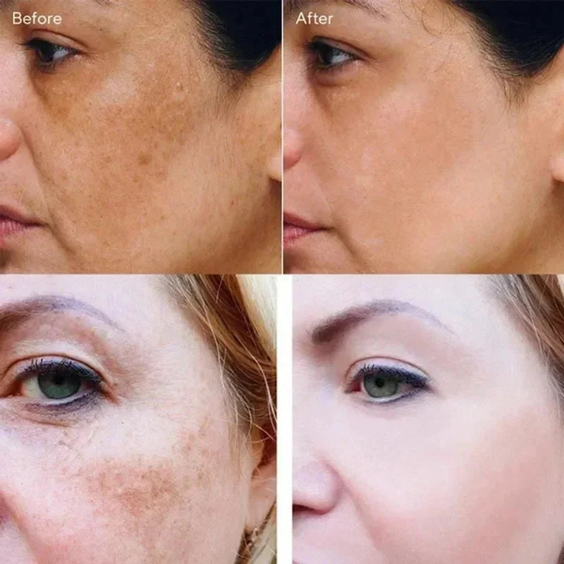 Powerful Dark Spots Remover Whitening Serum Face Freckle Melanin Correcting Anti Pigmentation Brighten Skin Beauty Care Products