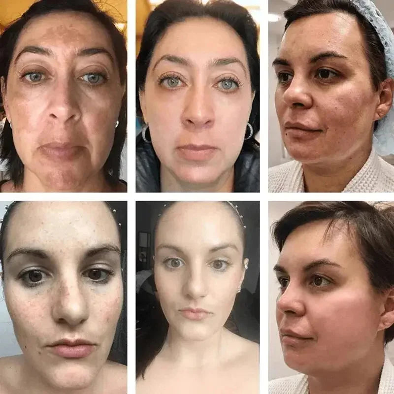 Powerful Spot-removing Whiten Cream Brighten Skin Fast Eliminates Melanin Pigmentation Melasma Dark Spots Moisturize Beauty Gel