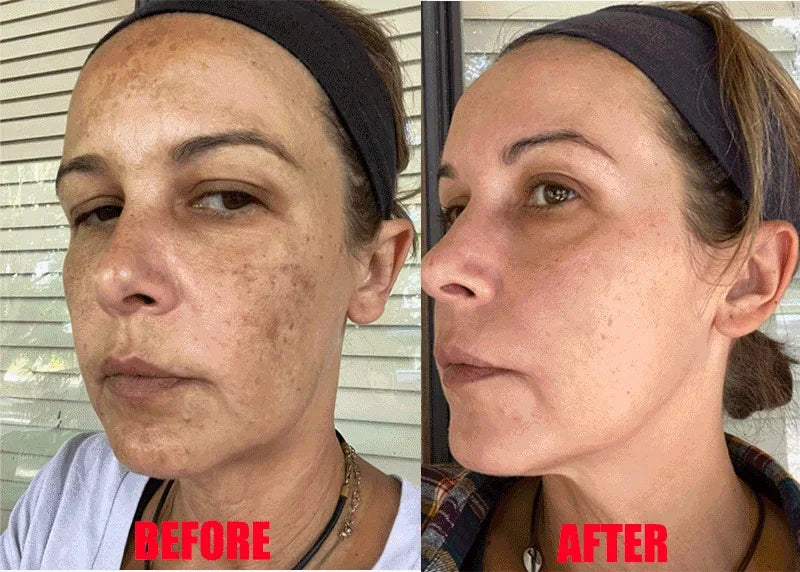 Vitamin C Whitening Freckles Serum Cream Remove Dark Spots Melasma Niacinamide Lighten Melanin Acne Scars Anti-aging Skin Care