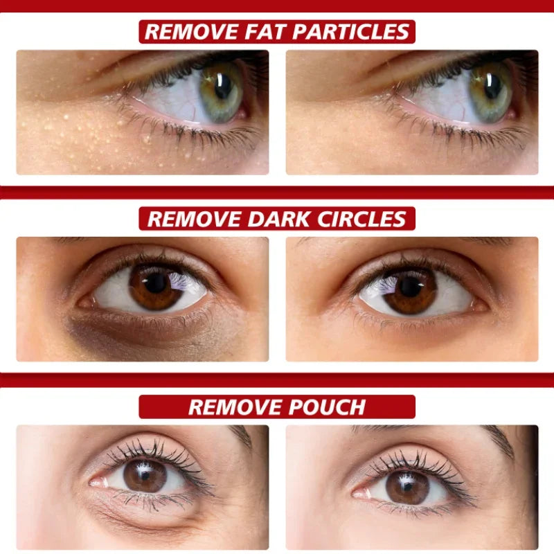 EyePure Fat Granule & Dark Circle Remover Eye Cream