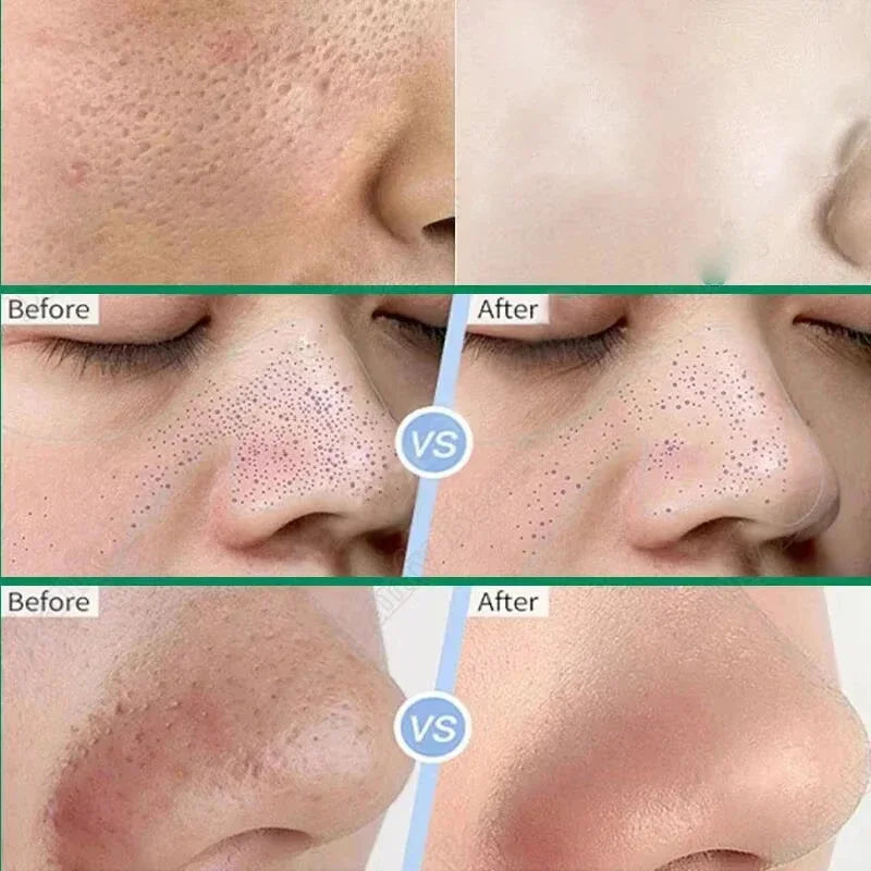 Salicylic Acid Pore Shrinking Mask Quick Elimination Large Pores Remove Blackehead Tighten Face Smooth Skin Korean Care Product