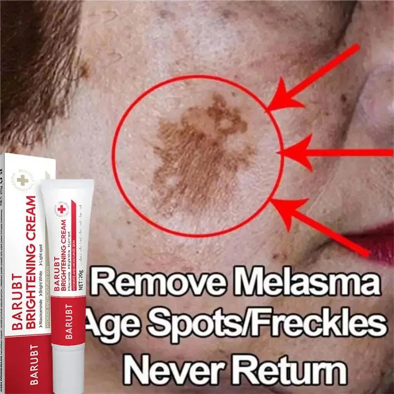 Powerful Spot-removing Whiten Cream Brighten Skin Fast Eliminates Melanin Pigmentation Melasma Dark Spots Moisturize Beauty Gel