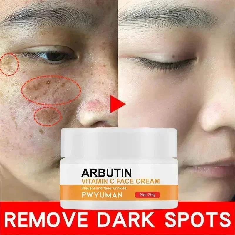 Vitamin C Whitening Freckles Serum Cream Remove Dark Spots Melasma Niacinamide Lighten Melanin Acne Scars Anti-aging Skin Care