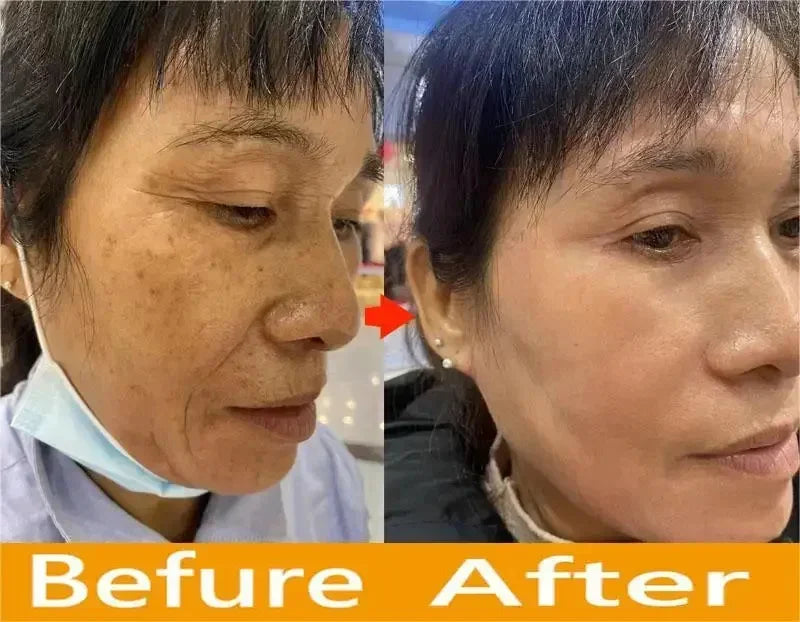 Powerful Dark Spots Remover Whitening Serum Face Freckle Melanin Correcting Anti Pigmentation Brighten Skin Beauty Care Products