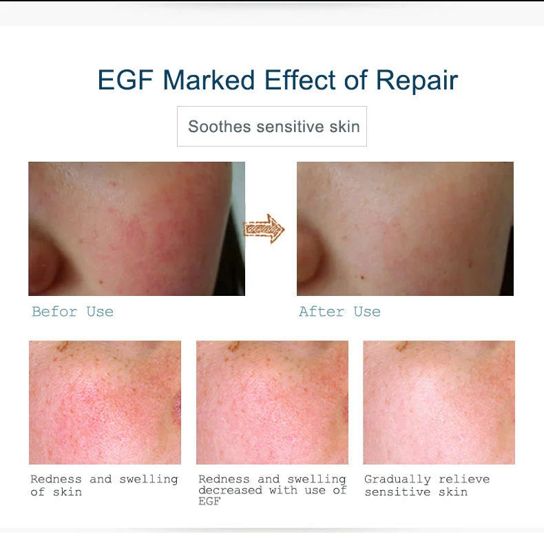 ARTISCARE EGF Acne & Blackhead Repair Face Serum