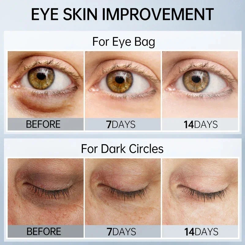 Eye Dark Circles Remover Cream Retinol Anti-aging Serum Remove Eye Bags Puffiness Fade Wrinkles Fine Lines Lift Firm Eye Care