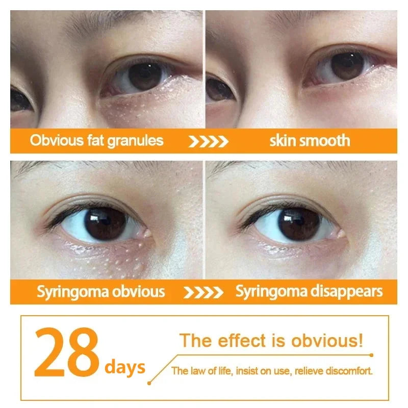 EyePure Fat Granule & Dark Circle Remover Eye Cream