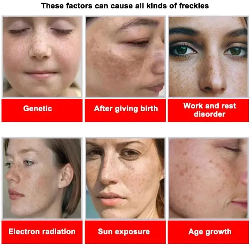 Powerful Spot-removing Whiten Cream Brighten Skin Fast Eliminates Melanin Pigmentation Melasma Dark Spots Moisturize Beauty Gel
