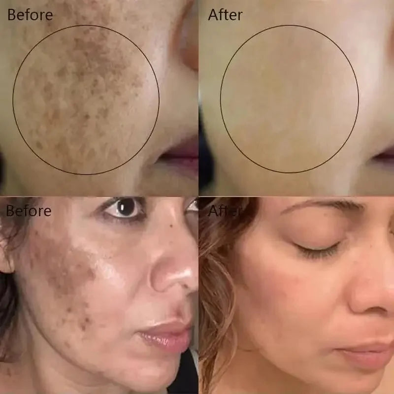 Powerful Spot-removing Whiten Cream Brighten Skin Fast Eliminates Melanin Pigmentation Melasma Dark Spots Moisturize Beauty Gel