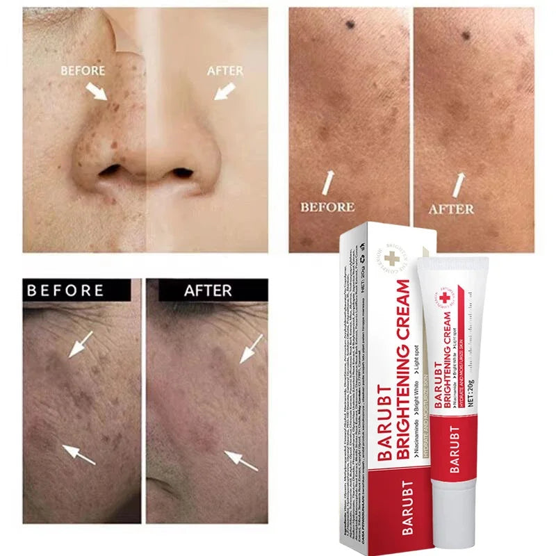 Powerful Spot-removing Whiten Cream Brighten Skin Fast Eliminates Melanin Pigmentation Melasma Dark Spots Moisturize Beauty Gel