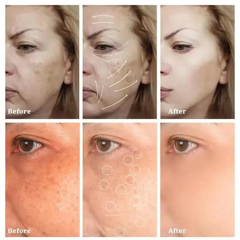 Powerful Spot-removing Whiten Cream Brighten Skin Fast Eliminates Melanin Pigmentation Melasma Dark Spots Moisturize Beauty Gel